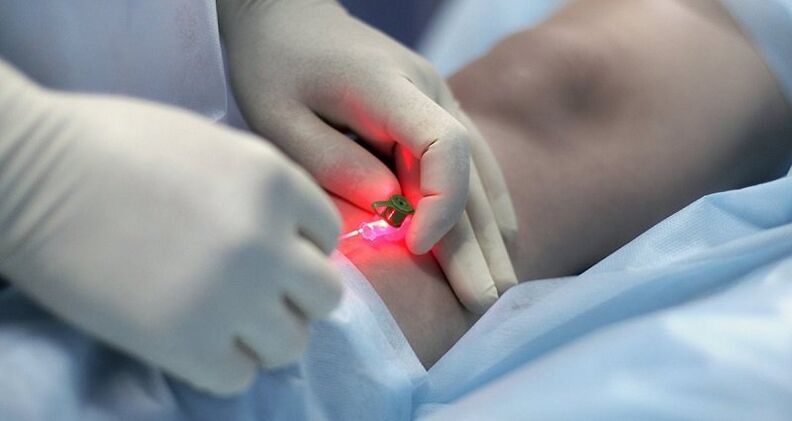 Hirurško liječenje proširenih vena