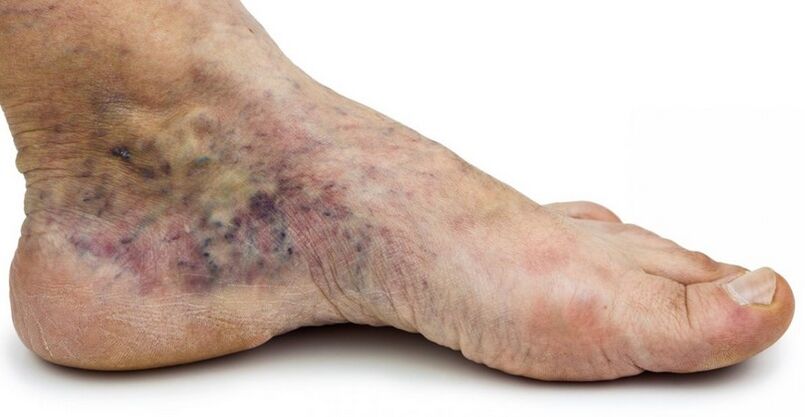 Stadij C4c – kruna stopala, flebitis u centru